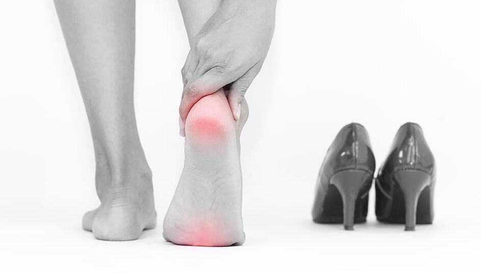 Indossare scarpe strette è la causa della micosi
