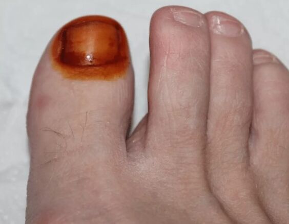 Trattamento del fungo iodio