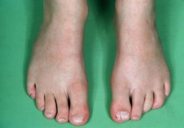 Il fungo sulle gambe