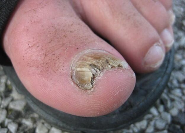 Il risultato di abbandono