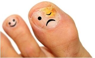 fungo giallo dell'unghia del piede