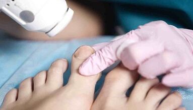 Trattamento hardware di funghi sulle gambe