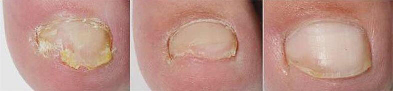 Risultati della terapia