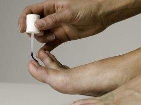 Trattamento del fungo delle unghie