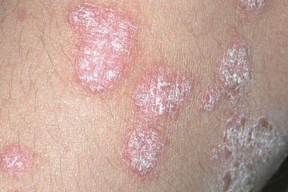 Psoriasi causata da un'infezione fungina