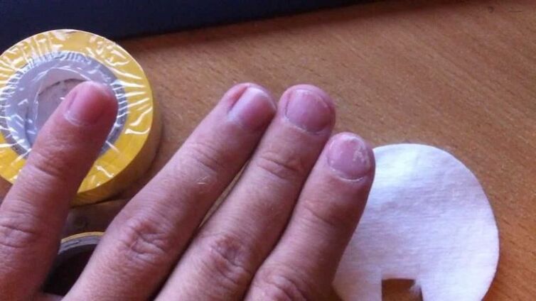 funghi delle unghie e il loro trattamento con rimedi popolari