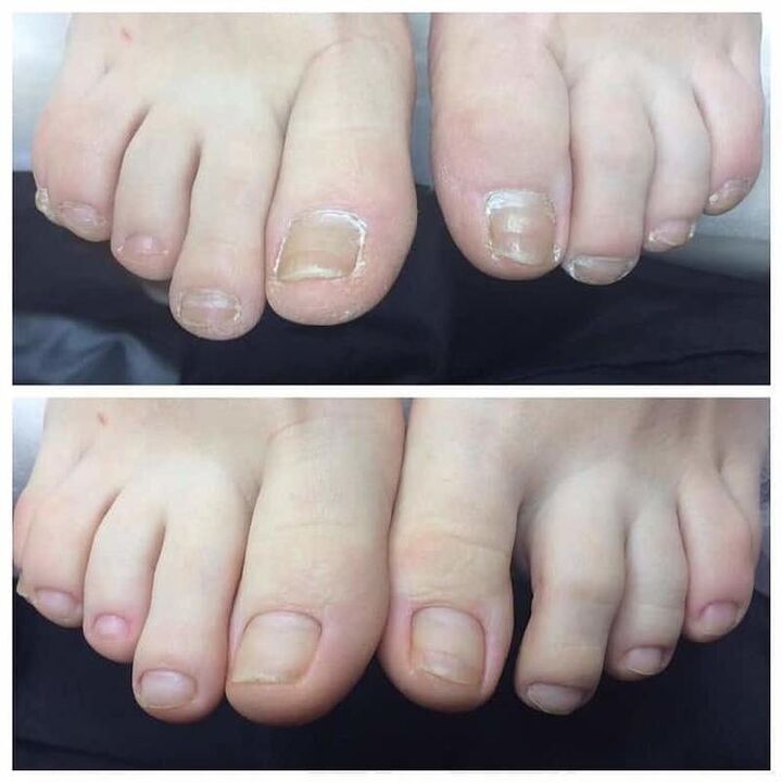 revisione dell'uso Exodermin